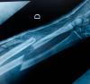 Radiographie d'un os cassé dans le bras